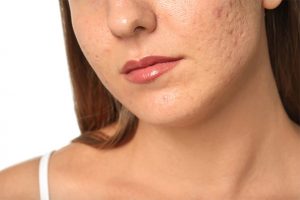 acne dermavida