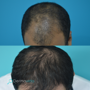 Dermavida Tratamientos Capilares _ Alopecia Hombres (1)