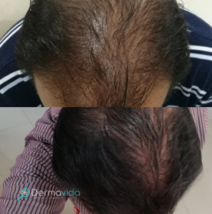Dermavida Tratamientos Capilares _ Alopecia Hombres