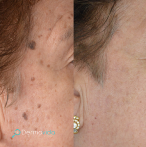 Dermavida Tratamientos anti edad _ Lunares (2)