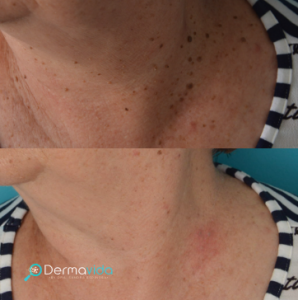 Dermavida Tratamientos anti edad _ Lunares